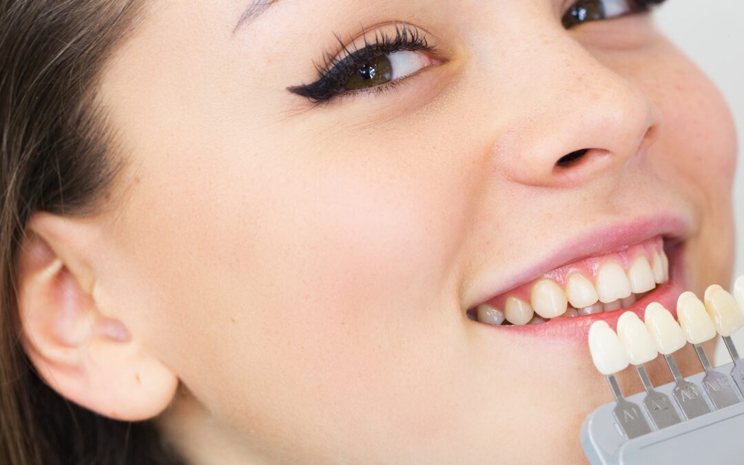 Λεύκανση δοντιών